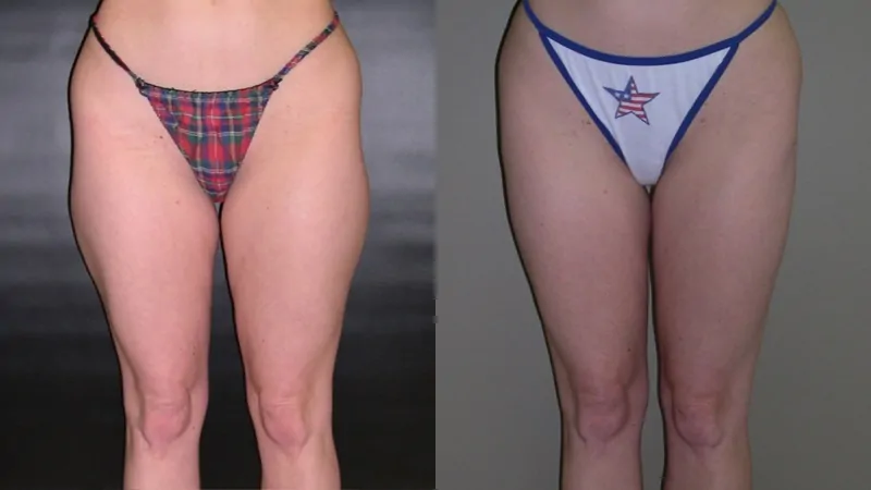 Before-and-after photos of liposuction performed by Dr. McGovern.