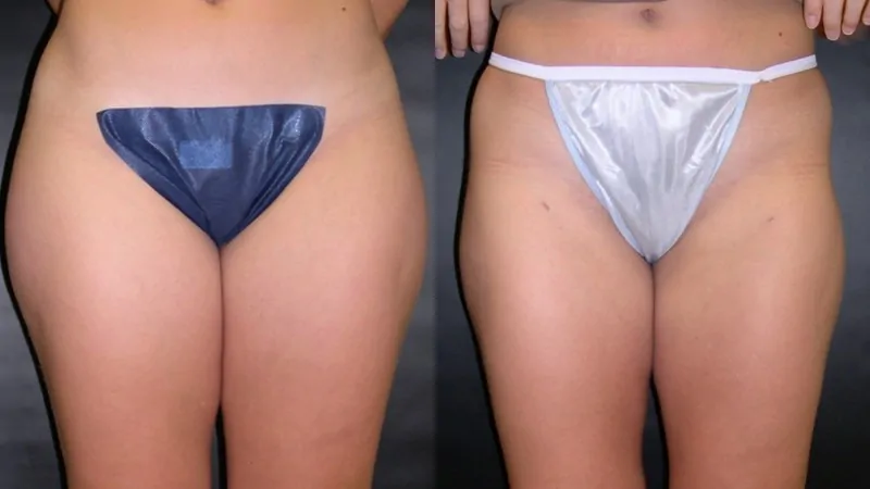 Before-and-after photos of liposuction performed by Dr. McGovern.