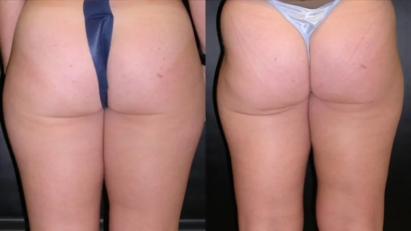 Before-and-after photos of liposuction performed by Dr. McGovern.
