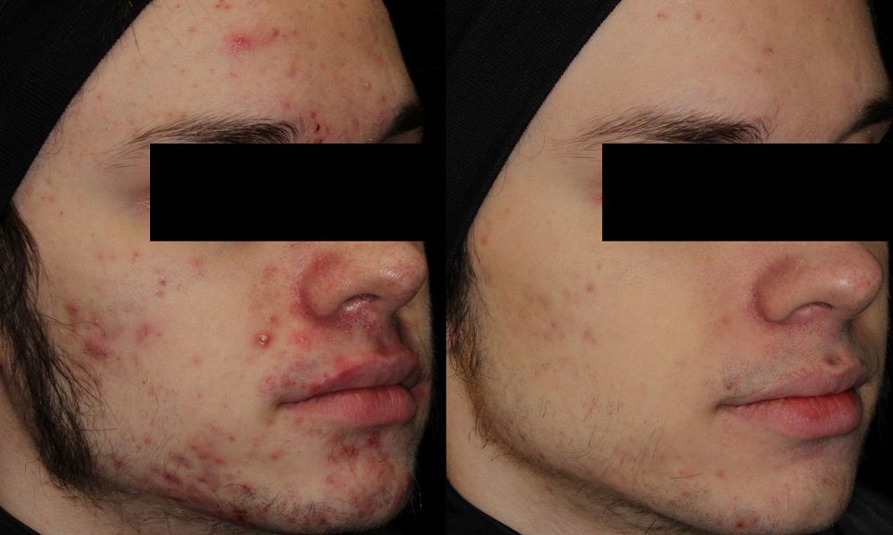 AviClear acne treatment results at RenewalMD in Savannah, GA