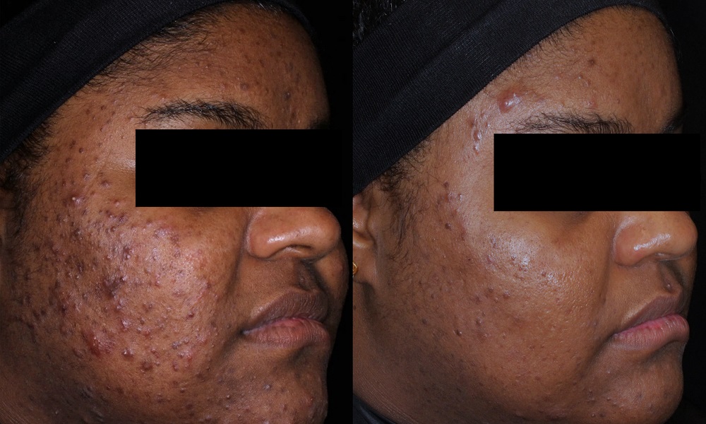 AviClear acne treatment results at RenewalMD in Statesboro, GA