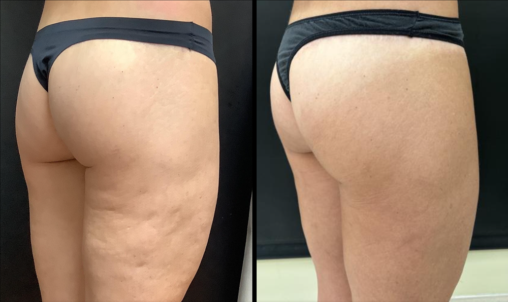 Aveli before-and-after photos at RenewalMD in Savannah, GA