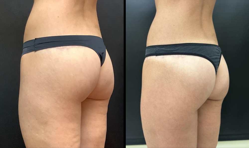 Aveli before-and-after photos at RenewalMD in Savannah