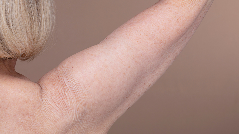 An older woman flexing her arm. Arm lift concept.
