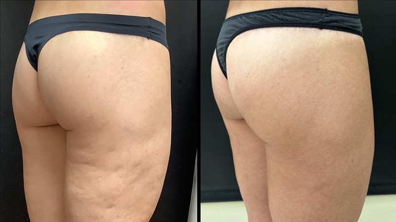 Before and after photos of an Aveli for Cellulite treatment.