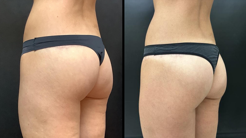 Before and after photos of an Aveli for Cellulite treatment.