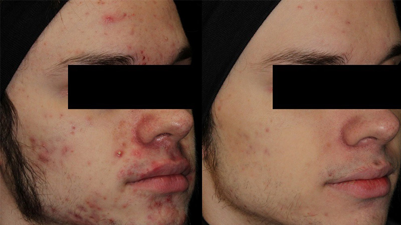 Before and after photos of AviClear Acne Treatment.