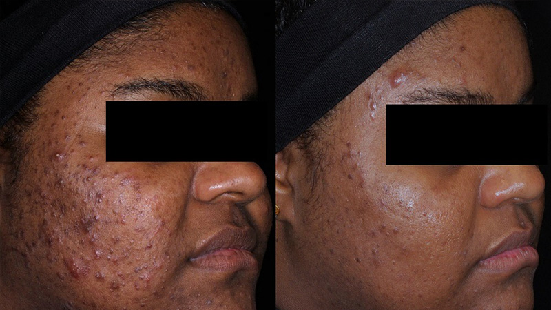 Before and after photos of AviClear Acne Treatment.