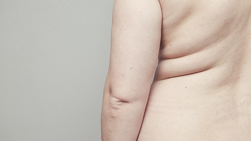 A woman with body folds. Body lift concept.
