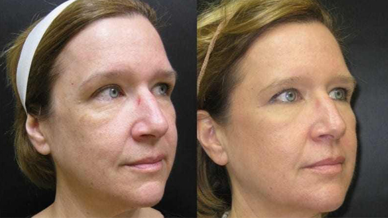 Before and after photos of an Ultherapy treatment.