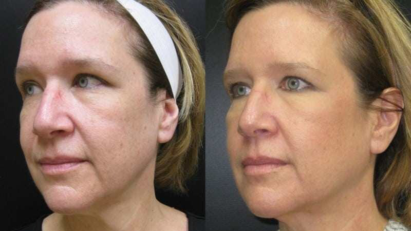 Before and after photos of an Ultherapy treatment.