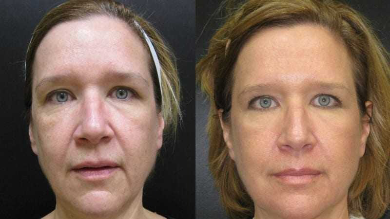 Before and after photos of an Ultherapy treatment.