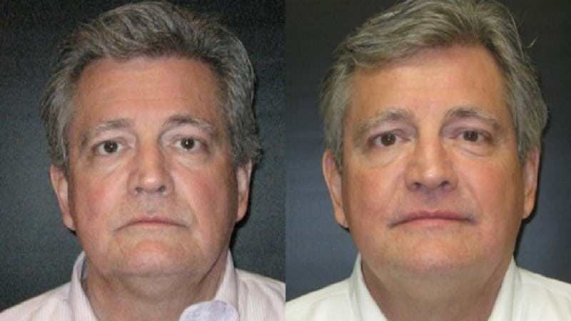 Before and after photos of an Ultherapy treatment.