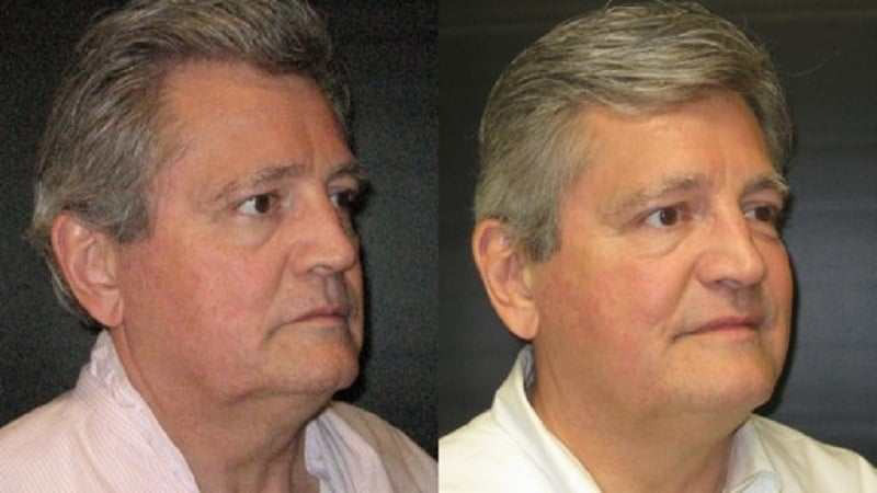 Before and after photos of an Ultherapy treatment.