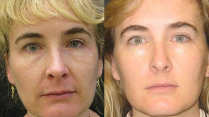 Before and after photos of an Ultherapy treatment.