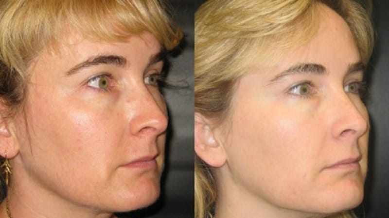 Before and after photos of an Ultherapy treatment.