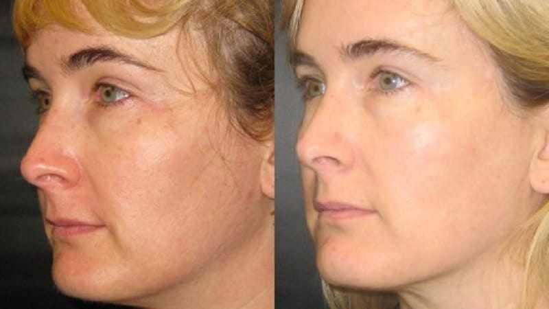 Before and after photos of an Ultherapy treatment.