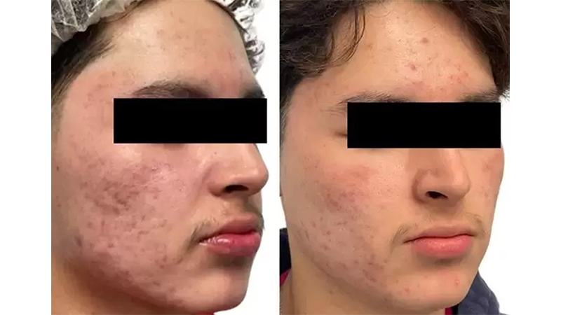 Before and after photos of an AquaFirmeXS treatment.