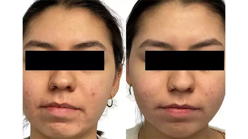 Before and after photos of an AquaFirmeXS treatment.