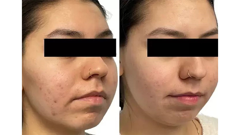 Before and after photos of an AquaFirmeXS treatment.