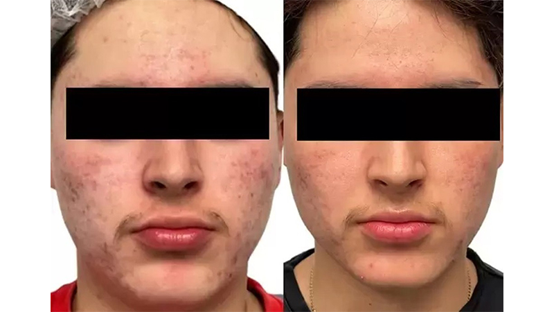 Before and after photos of an AquaFirmeXS treatment.