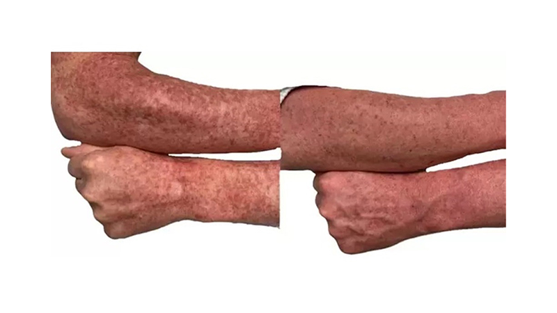 Before and after photos of an AquaFirmeXS treatment.