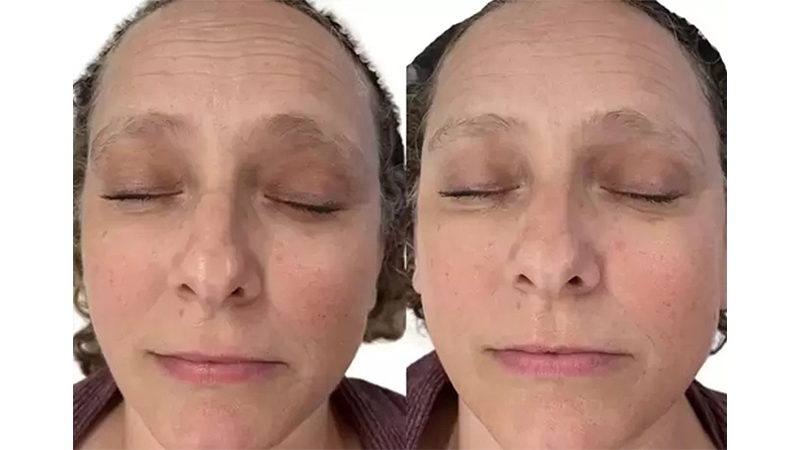 Before and after photos of an AquaFirmeXS treatment.