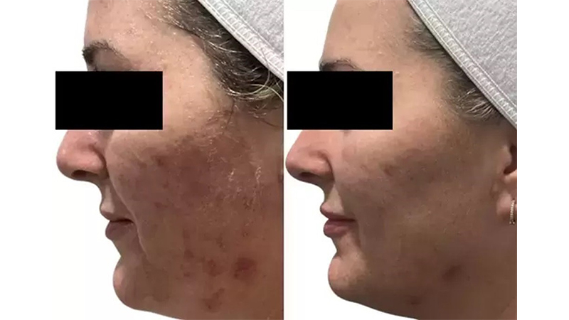 Before and after photos of an AquaFirmeXS treatment.