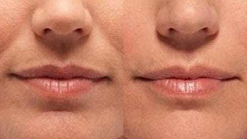 Before and after images of a Thermi treatment.