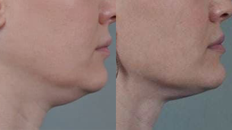 Before and after images of a Thermi treatment.