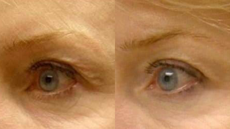 Before and after images of a Thermi treatment.