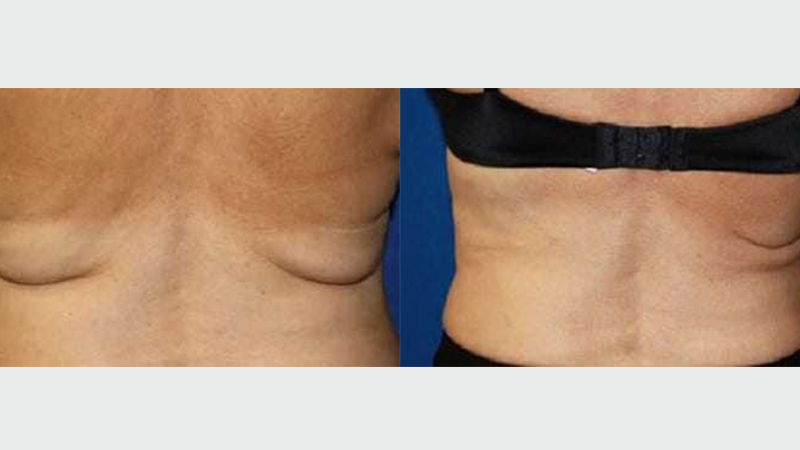 Before and after images of a Thermi treatment.