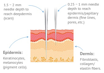 A diagram of microneedling.