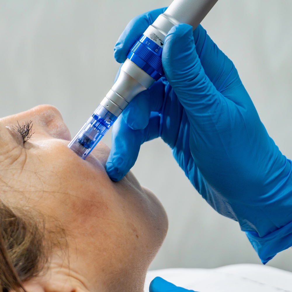 Skin Rejuvenation Essentials: Laser Treatments and Microneedling Explained
